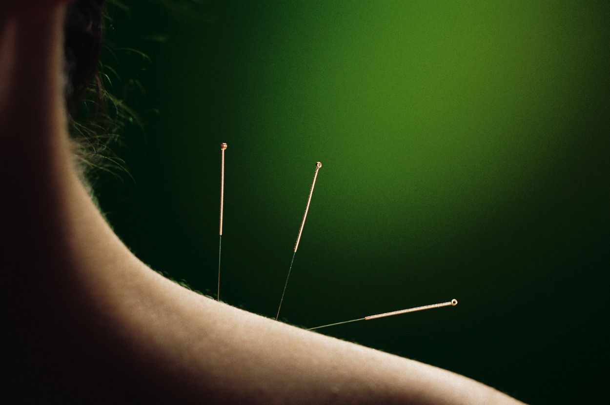 History of Traditional Acupuncture in London